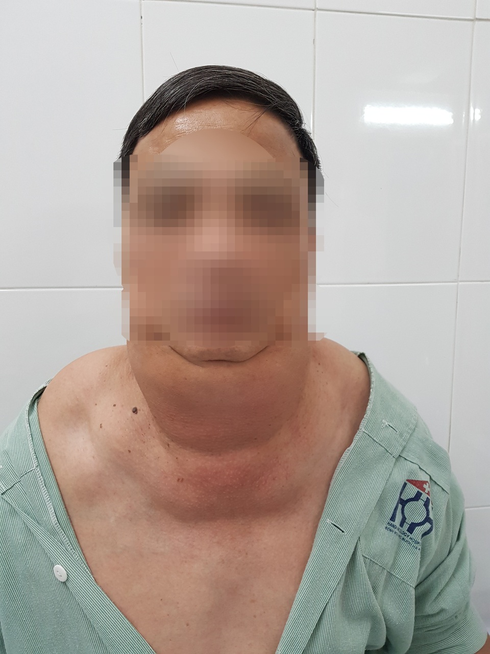 Uống 1 lít rượu mỗi ngày, người đàn ông phát hoảng vì chiếc cổ kỳ dị - 1 Uống 1 lít rượu mỗi ngày, người đàn ông phát hoảng vì chiếc cổ kỳ dị - 1