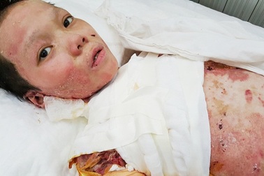 Cháu bé nướng khoai bị bỏng nặng đã được phẫu thuật ghép da