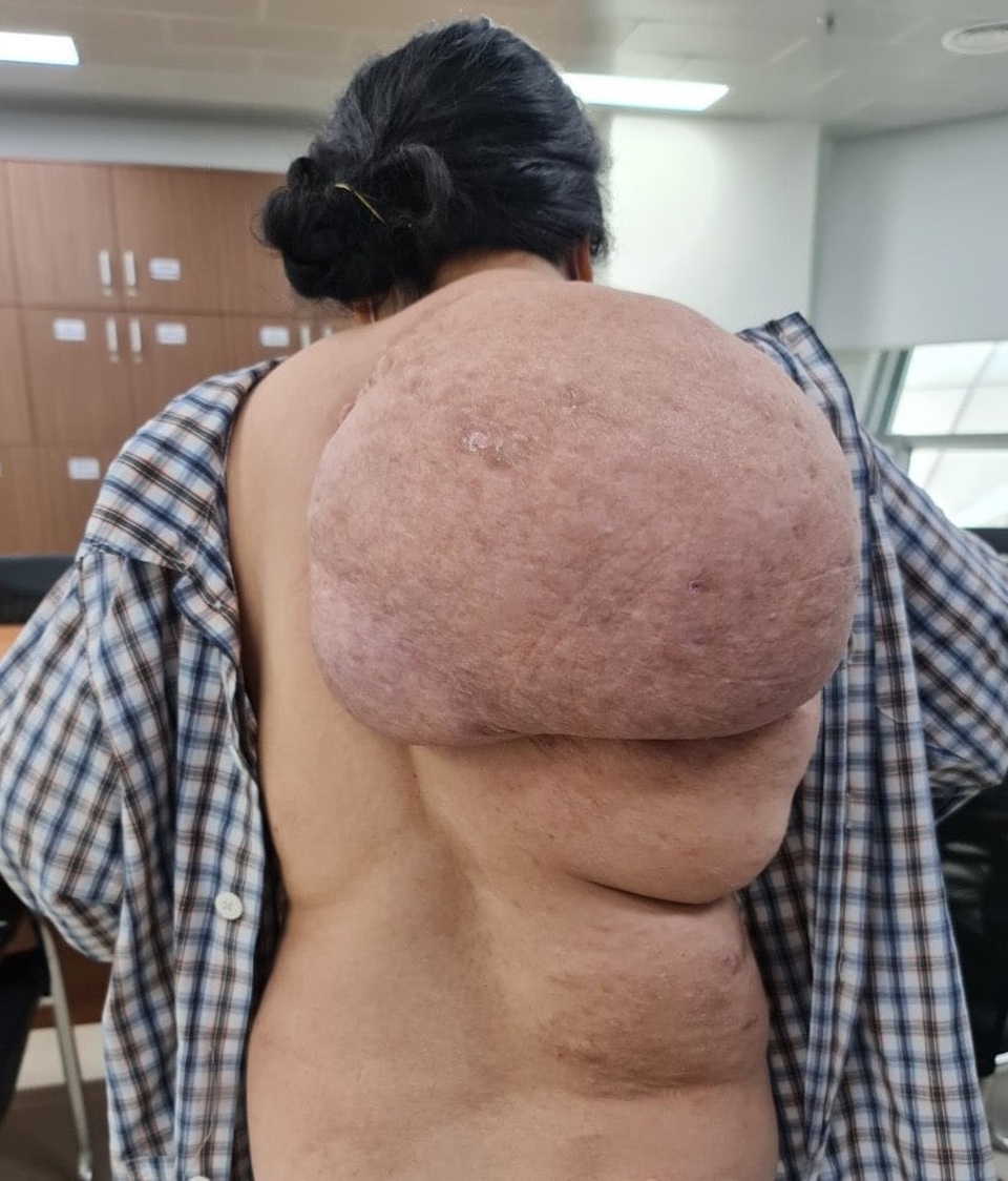 Người phụ nữ mang khối u khổng lồ trên vai như mai rùa - 1 Người phụ nữ mang khối u khổng lồ trên vai như mai rùa - 1