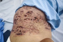 Da như tổ ong sau khi đắp đậu xanh chữa zona thần kinh