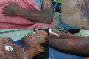 Căn bệnh nguy hiểm bắt nguồn từ món tiết canh