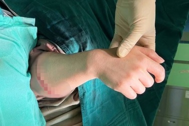Khoảnh khắc cẳng tay đứt lìa được nối liền sau hơn 6 giờ phẫu thuật