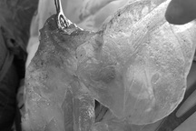 Vỡ túi silicon, người phụ nữ phát hiện u ở ngực