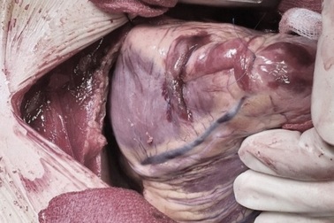 Bác sĩ chạy đua với “tử thần” cứu bệnh nhân bị dập tim