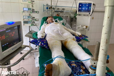 Xót xa hoàn cảnh người bố 4 con bị bỏng 85% cơ thể
