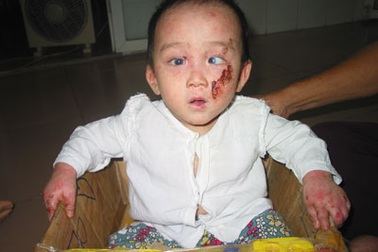 Bệnh nhân thứ 3 được ghép tế bào gốc từ tủy xương điều trị bệnh “lột da ếch”