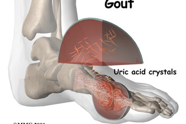 Điều trị bệnh gút thế nào cho hiệu quả?