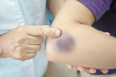 Có những triệu chứng này, gan đã bị tổn thương nặng không thể hồi phục