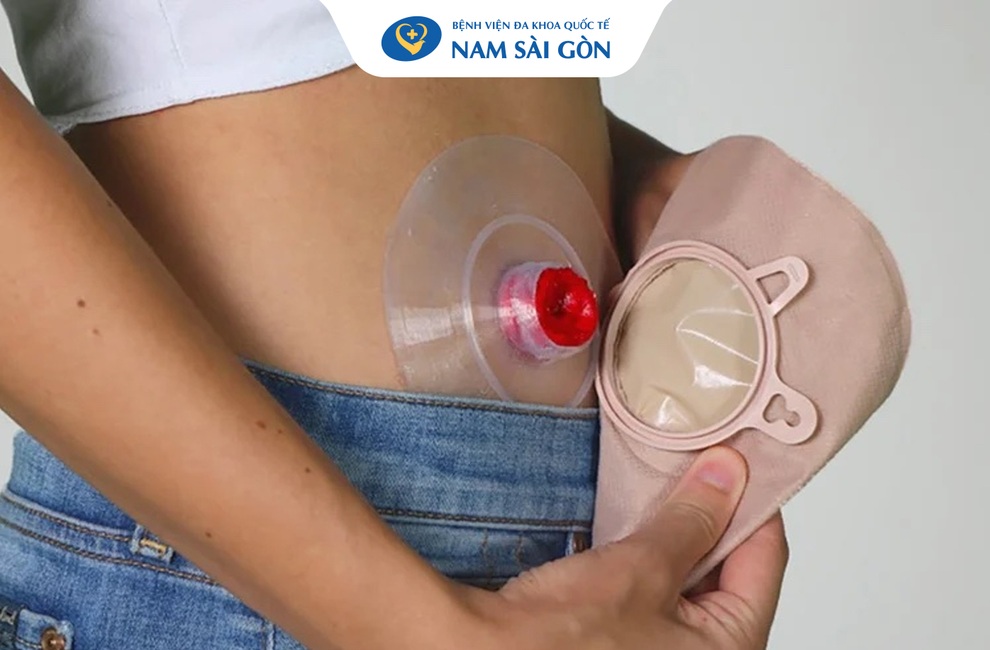 Phẫu thuật tạo hình bàng quang bằng ruột non - 3 Phẫu thuật tạo hình bàng quang bằng ruột non - 3