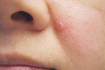 Ba dấu hiệu dễ bỏ qua của ung thư da