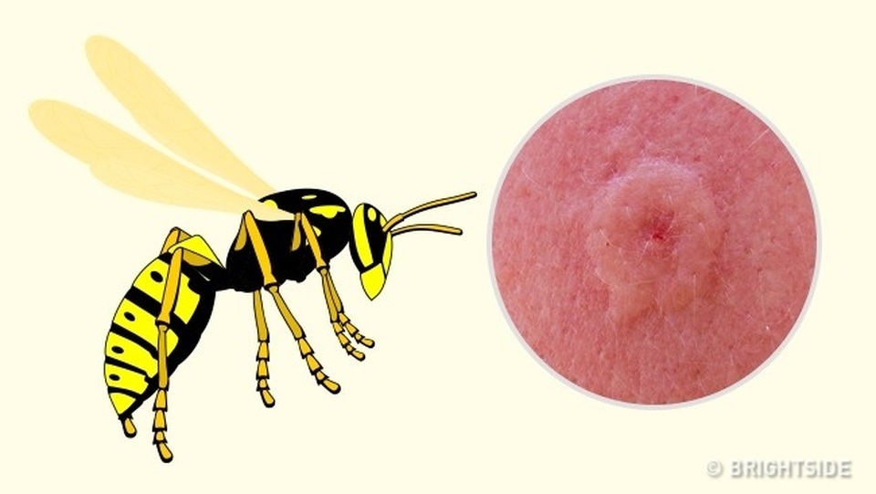 Cách phân biệt 10 vết côn trùng cắn - 3 Cách phân biệt 10 vết côn trùng cắn - 3