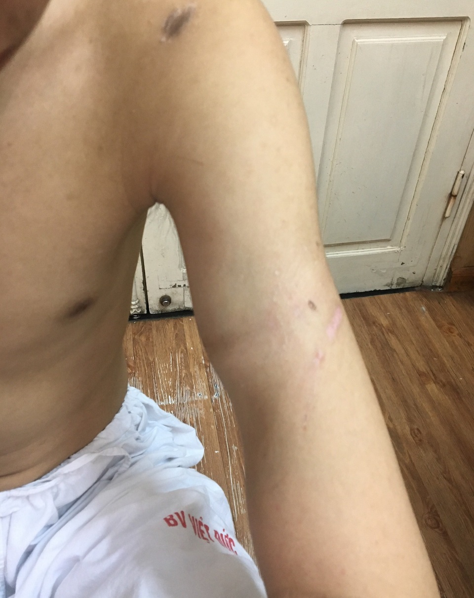 Nam sinh bị máy tiện quấn đứt cánh tay, gia đình bức xúc đòi hỗ trợ! - 8 Nam sinh bị máy tiện quấn đứt cánh tay, gia đình bức xúc đòi hỗ trợ! - 8