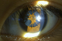 Căn bệnh oái oăm khiến nữ sinh bị màng che kín 2 mắt