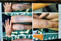 Vụ học sinh bầm tím chân: Cô giáo tạm thời không đứng lớp