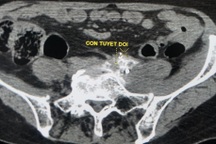 Giảm đau cho bệnh nhân ung thư như thế nào?