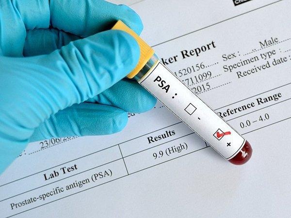 Chỉ số PSA bao nhiêu cảnh báo nguy cơ ung thư tuyến tiền liệt? - 1 Chỉ số PSA bao nhiêu cảnh báo nguy cơ ung thư tuyến tiền liệt? - 1