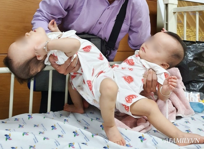 Bác sĩ tiết lộ khoảnh khắc cuối cùng ca mổ song sinh Trúc Nhi – Diệu Nhi: Vừa bó bột xong là… muốn gục - Ảnh 1. Bác sĩ tiết lộ khoảnh khắc cuối cùng ca mổ song sinh Trúc Nhi – Diệu Nhi: Vừa bó bột xong là… muốn gục - Ảnh 1.