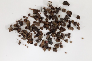 Phẫu thuật thành công sỏi thận tảng san hô hiếm gặp