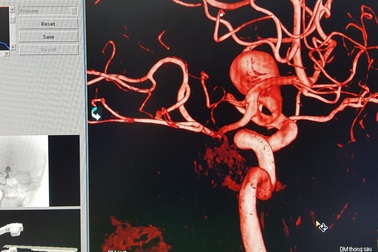 Đau đầu dữ dội vì túi phình khổng lồ ở động mạch não