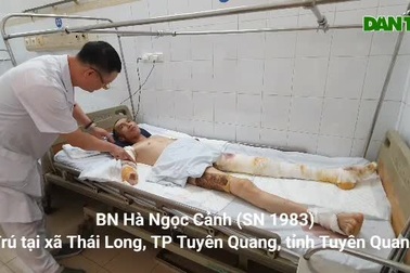 Bỏng điện cao thế, người thợ xây bị mất đôi tay