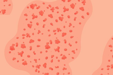 9 câu hỏi giúp “giải mã” các phát ban trên da