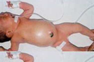 Những tai biến khi chăm sóc cuống rốn 