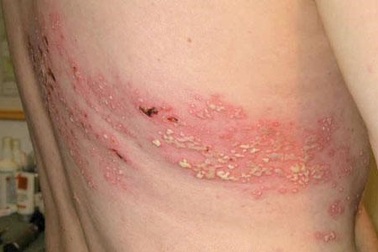 Những điều cần biết về bệnh zona thần kinh