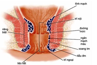 Điều trị bệnh trĩ tận gốc
