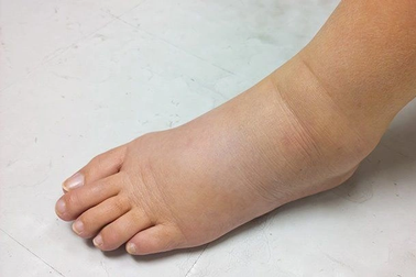Những bất thường ở chân cảnh báo ung thư trong cơ thể