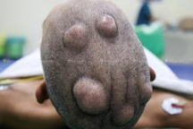 Kỳ lạ người đàn ông mọc chi chít hàng chục khối u trong 12 năm