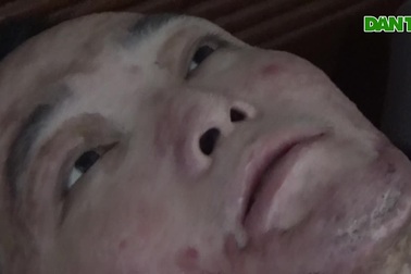 Cảnh sống không bằng chết của người đàn ông bị tẩm xăng thiêu