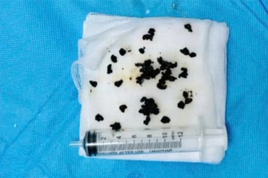 Gắp hàng chục mảnh sỏi từ đường mật gan cô gái trẻ