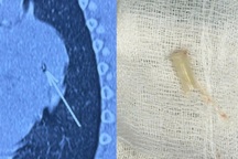 Bé trai 7 tuổi phải đi cấp cứu ở 3 bệnh viện vì "thở ra tiếng kèn"