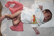 Sự sống mong manh của bé 3 tháng tuổi mắc bệnh tim bẩm sinh nặng 