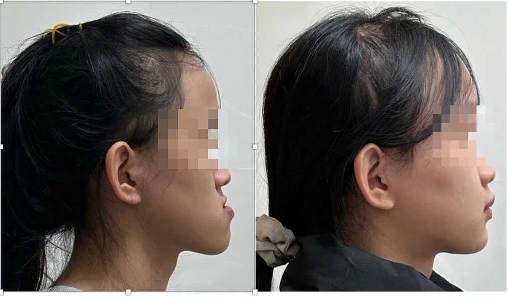 Làm sao xử lý gương mặt lưỡi cày? - 3 Làm sao xử lý gương mặt lưỡi cày? - 3