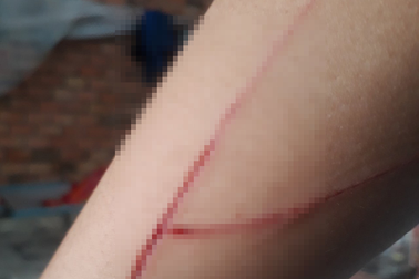 Thông tin bất ngờ liên quan bé gái trong vụ án hiếp dâm bị rạch tay