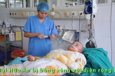 Cậu bé 13 tuổi bị bỏng xăng 90% cơ thể giành giật sự sống.