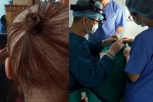 Dùng thuốc kích thích mọc tóc, cô gái trẻ bị rụng tóc đến... trọc đầu