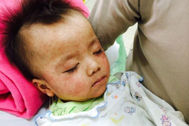 Hà Nội: Bùng phát dịch sởi ở trẻ em