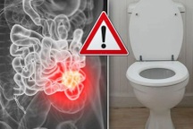 90% bệnh nhân ung thư đường ruột sẽ có những triệu chứng này khi đi vệ sinh
