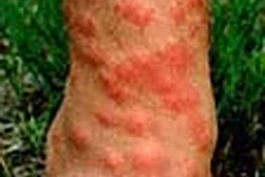 Bệnh viêm da do ấu trùng sán máng