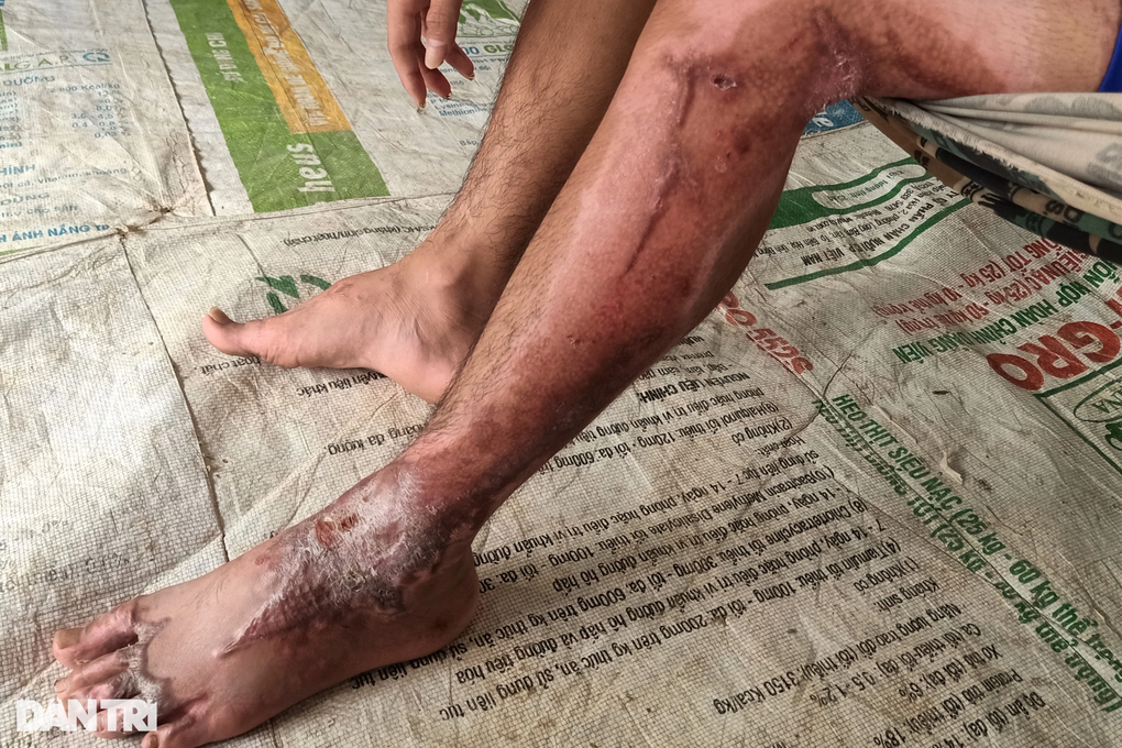 Bị tai nạn, chàng trai hiếu thảo mong có tiền lắp tay giả, phụ mẹ nuôi em - 4 Bị tai nạn, chàng trai hiếu thảo mong có tiền lắp tay giả, phụ mẹ nuôi em - 4