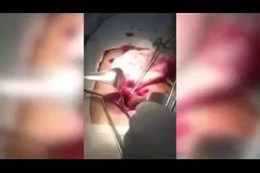 Rợn người cảnh lấy 18 chiếc bàn chải đánh răng ra khỏi dạ dày