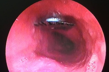 Viên thuốc còn nguyên vỉ đóng ngang thực quản bệnh nhân