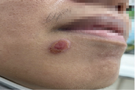 TPHCM: Nhiều chàng trai nhiễm bệnh hiểm sau quan hệ với bạn tình đồng giới