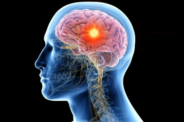 Đột phá: Xét nghiệm nước tiểu có thể phát hiện sớm khối u não