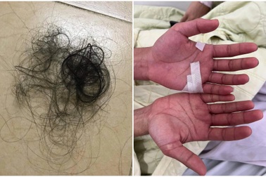 Hà Nội: Người trẻ tóc rụng từng nắm, ngứa phát rồ "hậu sốt xuất huyết"