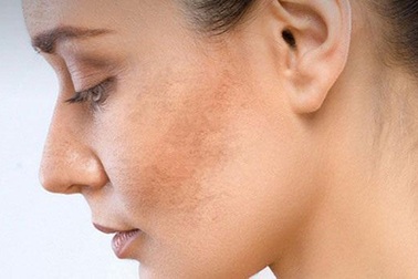 Chia tay nám “khó hóa dễ” nếu bạn biết đến Glutathione BC White