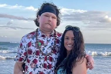 Người đầu tiên trên thế giới được ghép mặt đã tìm thấy tình yêu