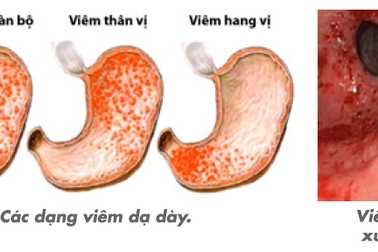 Bí quyết giúp tránh tái phát viêm loét dạ dày